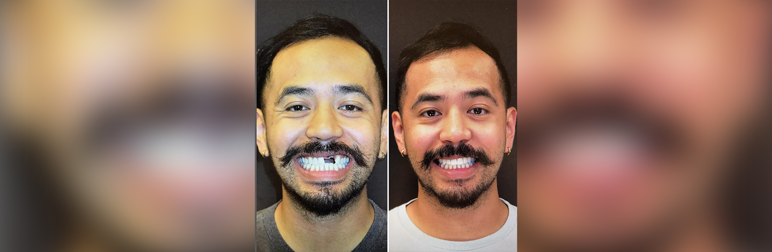 Dental bridges at Modern Dental Care