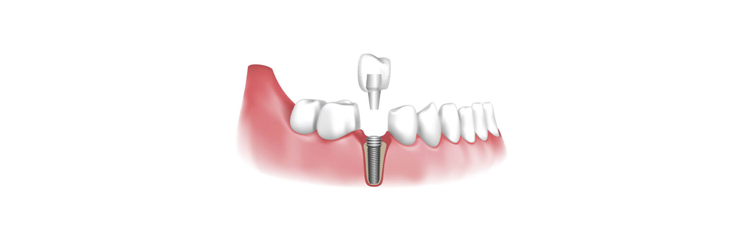 Top 7 Advantages of Dental Implants for a Strong and Natural Smile