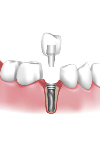 Top 7 Advantages of Dental Implants for a Strong and Natural Smile
