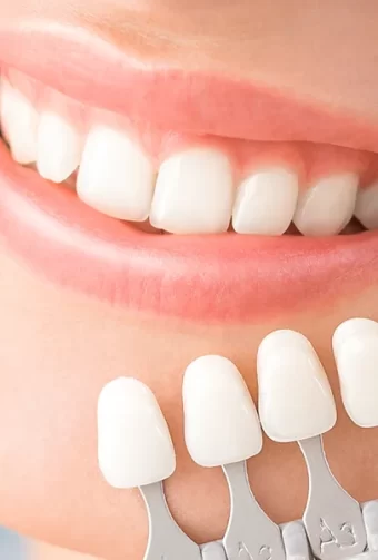 Smile Brighter with Dental Veneers in Las Vegas: Procedure, Care, and Results