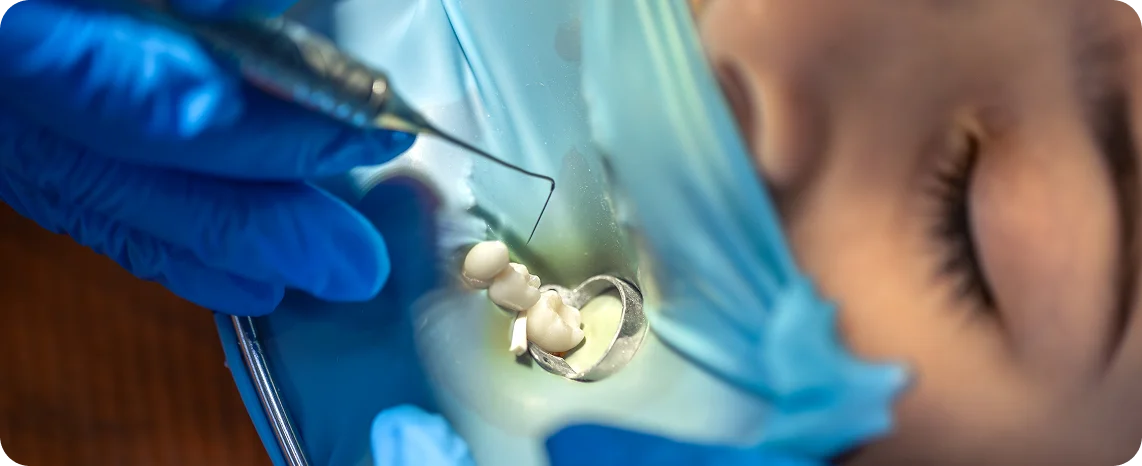How Do Fillings Work?
