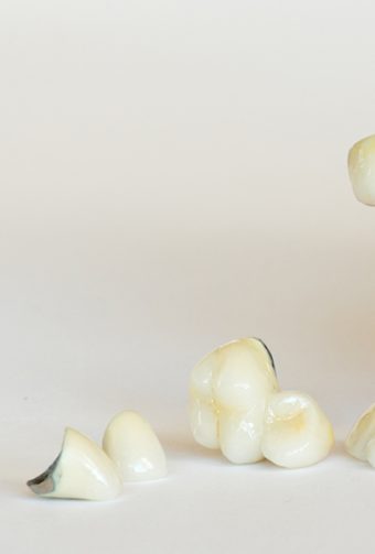 Which Type Of Dental Crown Should You Choose?
