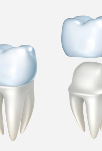 Why Is One Dental Crown Better Than Another?