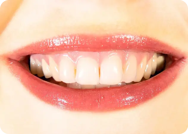 Common Causes of Tooth Discoloration