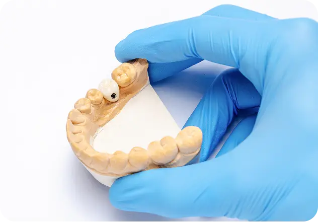 Dental Crowns at Modern Dental Care