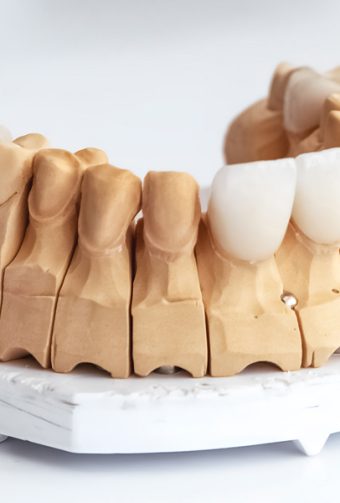 Dental Veneers in Las Vegas: Cost, Procedure & Benefits Explained (2026 Guide)