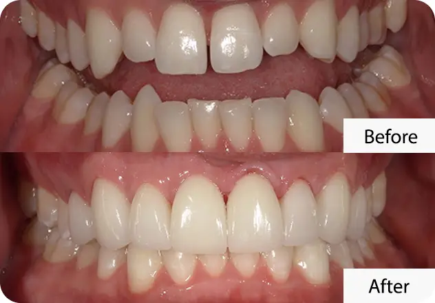 What Exactly Are Veneers?