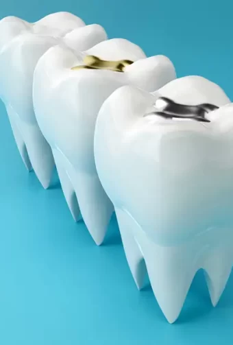 Is a Cavity Filling Covered by Insurance? A Guide for Las Vegas Patients