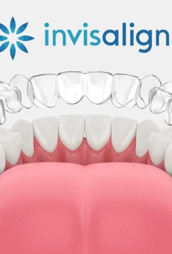 Invisalign Refinements: Why Some Patients Need Additional Aligners